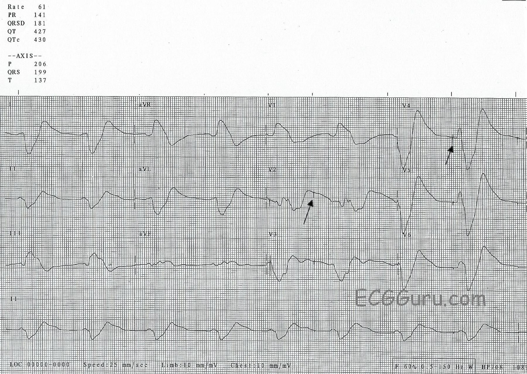 Sine Wave Hyperkalemia Ecg Changes